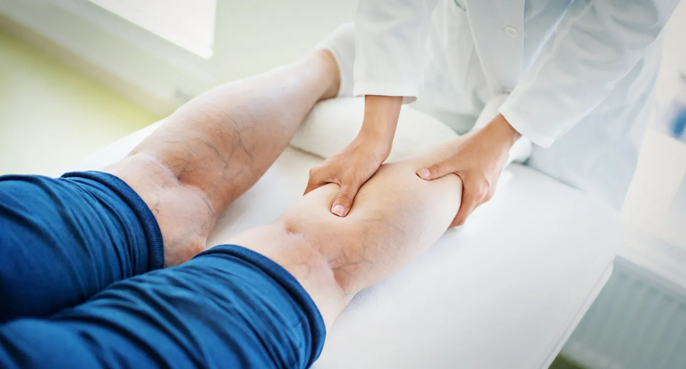 Mala Circulación en las Piernas: Síntomas y Como mejorarlo